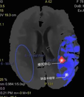 頭顱CTA+ CTP一站式成像