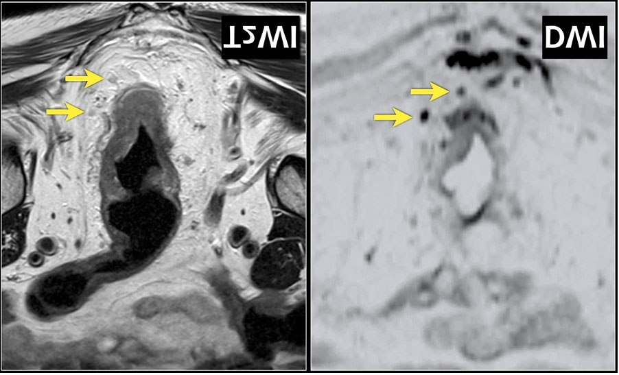 術(shù)前直腸癌的評估——高分辨直腸MRI