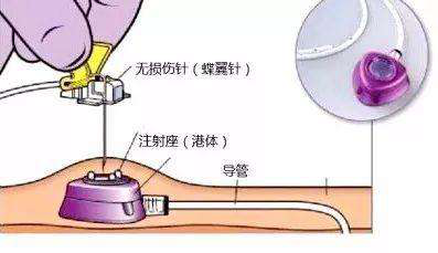 我院成功開展輸液港維護技術(shù)，填補我院靜脈治療領(lǐng)域又一空白